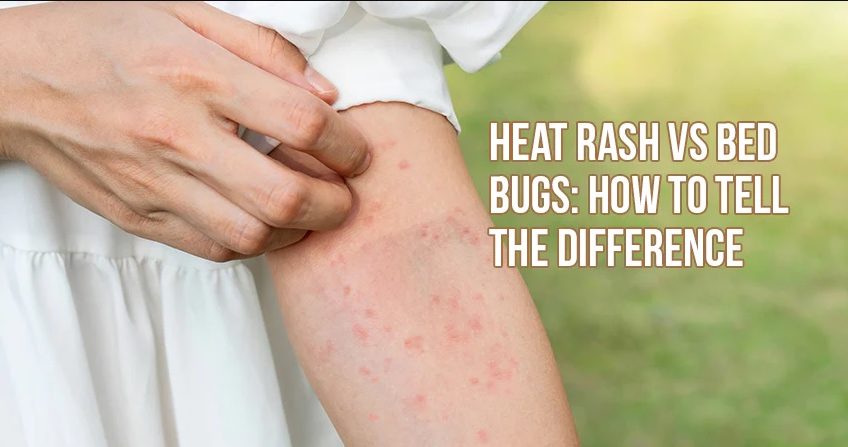 heat rash vs bed bug infestation