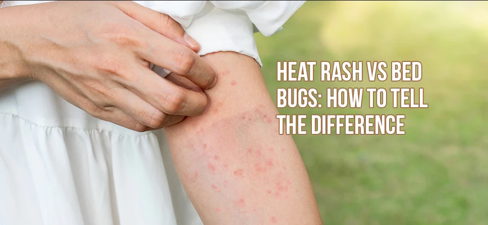 Spotting the Differences: Heat Rash versus Bed Bug Infestation