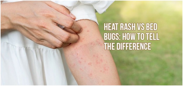 heat rash vs bedbugs