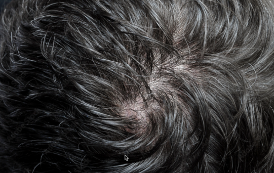 hair | Nashville Bed Bugs